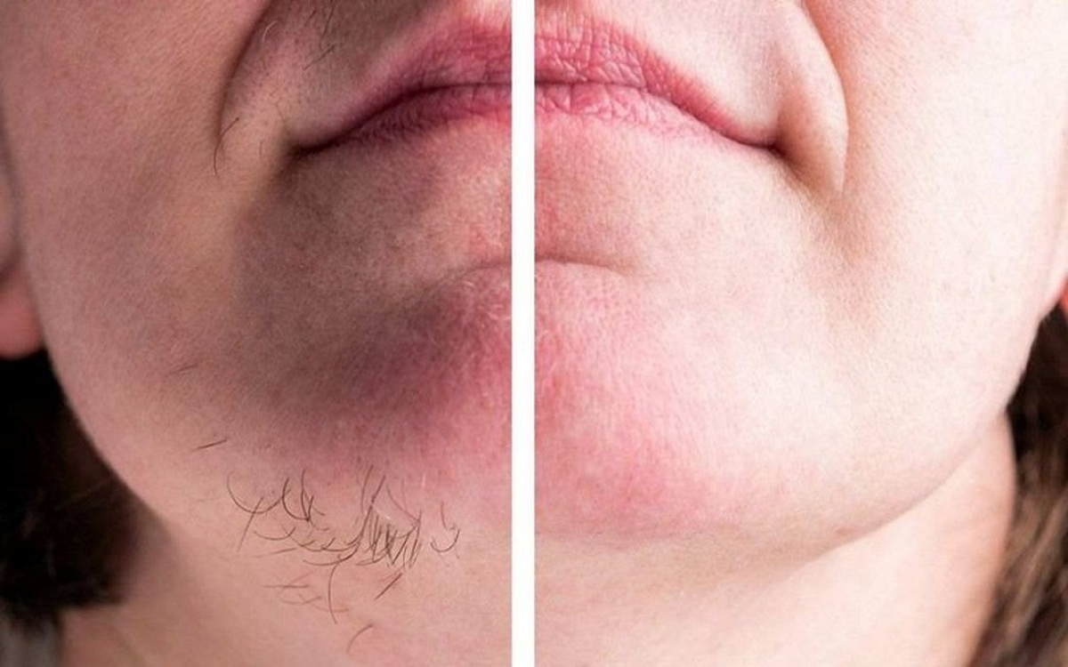 m/چگونه موهای زائد را از بین ببریم؟